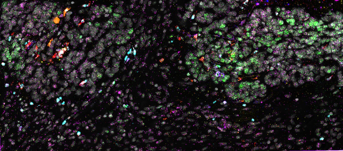 RNAscope HiPlex v2 assay: 12 RNA target detection in human ovarian cancer​