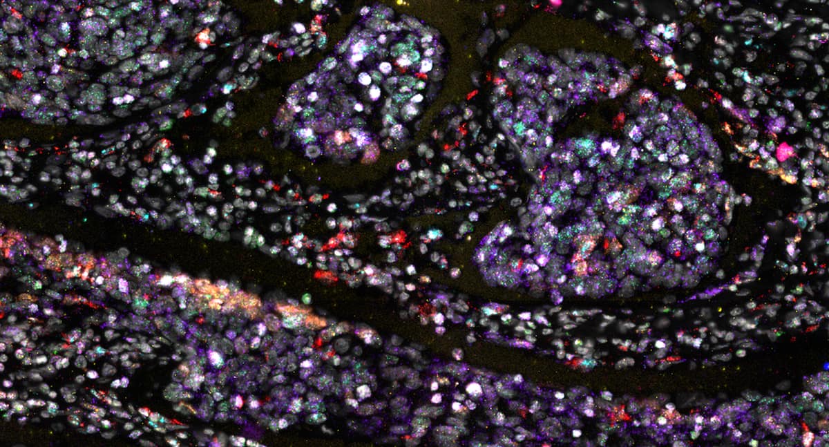 RNAscope HiPlex v2 assay: 12 RNA target detection in human cervical cancer