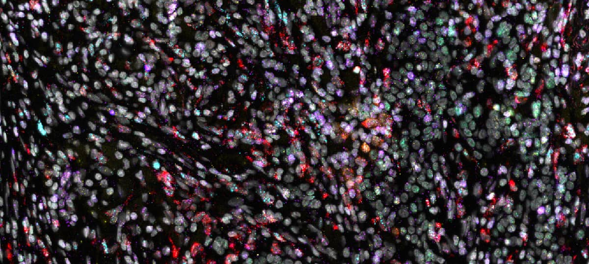 RNAscope HiPlex v2 assay: 12 RNA target detection in human breast cancer​