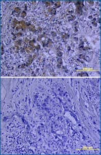 VEGF detected in immersion fixed paraffin-embedded sections of human breast cancer tissue