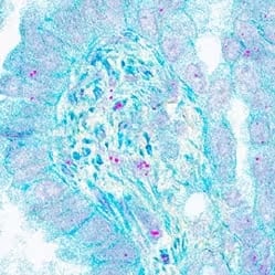 In situ detection of CD4+ Th1 cells in human lung cancer using Dual RNAscope in situ hybridization (ISH)/Immunohistochemistry (IHC)