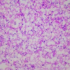 Hematoxylin and Eosin-stained brain tissue slide with Parkinson’s pathology.