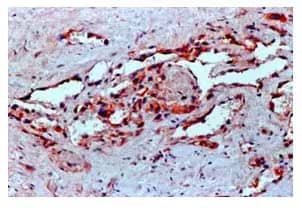 VEGF Expression in Human Angiosarcoma IHC