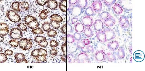 Dual ISH-IHC validation of CA IX specificity with left image showing IHC staining (brown) and left image showing ISH staining (red). Circular orthogonal validation strategies badge. 