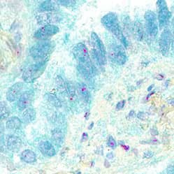 Co-detection of PD-1 and PD-L1 in human lung cancer by Dual RNAScope ISH/IHC.