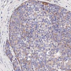 IHC-Paraffin (IHC-P) analysis of a formalin-fixed paraffin-embedded (FFPE) human breast carcinoma tissue section