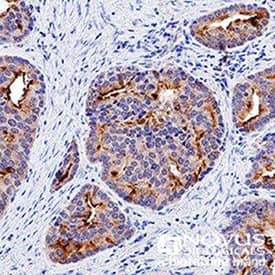 immunohistochemistry image showing p53 staining in human prostate cancer cells 