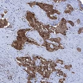 Immunohistochemistry image showing VEGF staining in human liver cancer tissue 