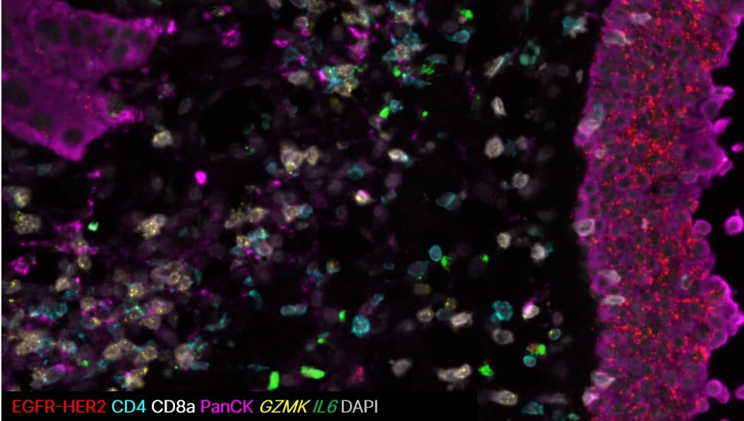 ProximityScope EGFR-HER2 heterodimerization (red) on head and neck cancer cells marked by PanCK (pink)