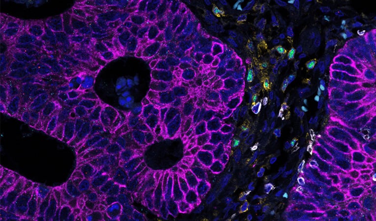 Detection of cytokines, immune and tumor cells using an RNAscope ​RNA-protein multiomic panel of 4 marker proteins, ​CD4 (yellow), CD8 (white), PanCK (pink), FoxP3 (green), and 2 target RNA probes, IFNG (red), GZMB (turquoise) in human colon cancer tissue