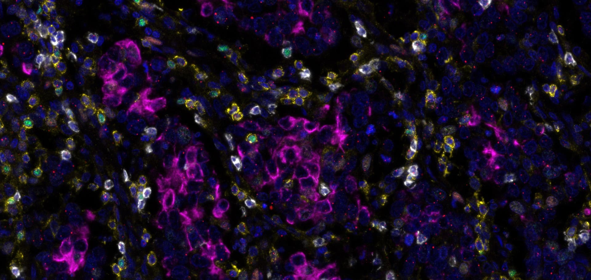 cervical cancer image - using RNAscope™ Multiomic LS Assay