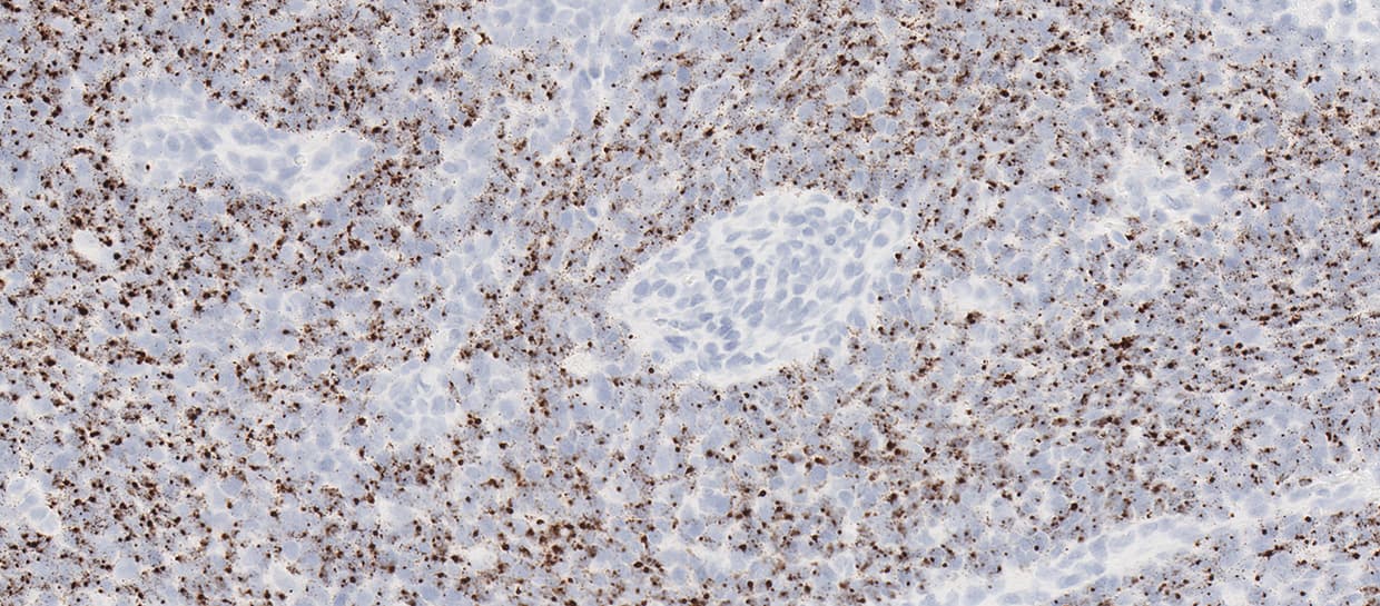 RNAscope image showing HPV-positive oropharyngeal squamous cell carcinoma