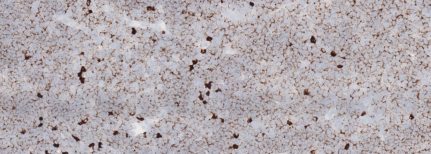 IgLamda staining in B cell Lymphoma with RNAscope ISH 