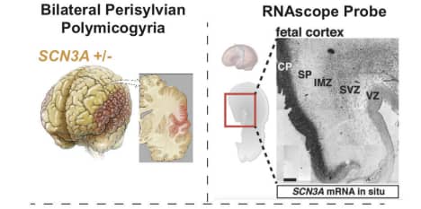 Figure 3. Pathophysiology of perisylvian polymicrogyria and SCN3A in situ gene expression pattern