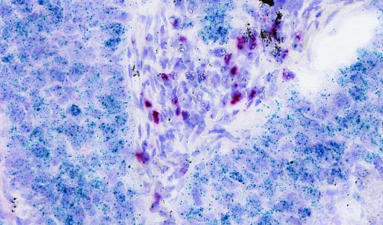 Simultaneous detection of CTLA4 (red) and PD-L1 (green) in NSCLC tissue using RNAScope 2.5 HD Duplex Assay