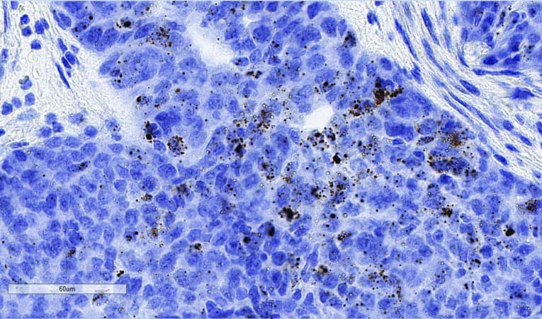  Detection of IL21A in human ovarian cancer using RNAscope 2.5 HD Brown Assay