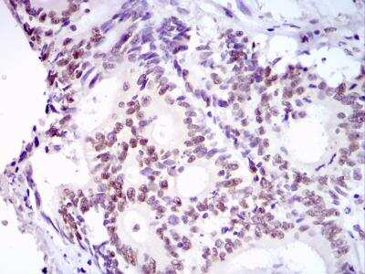 Immunohistochemical Staining of 53BP1 in Paraffin Embedded Colon Cancer