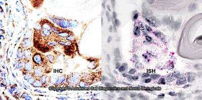 Dual RNAscope ISH-IHC Analysis of ABCA1 in Human Prostate Cancer Tissue