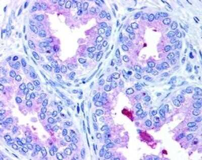 Immunohistochemical Staining of ABCA1 in Paraffin Embedded Human Prostate Epithelium