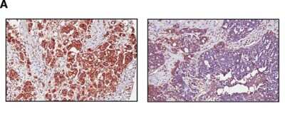 Immunohistochemical Staining of ABCA1 in Paraffin Embedded Ovarian Cancer Tissue