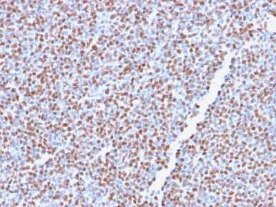 Immunohistochemistry-Paraffin: ALK/CD246 Antibody (ALK1/2766R) - Azide and BSA Free [NBP3-08447]