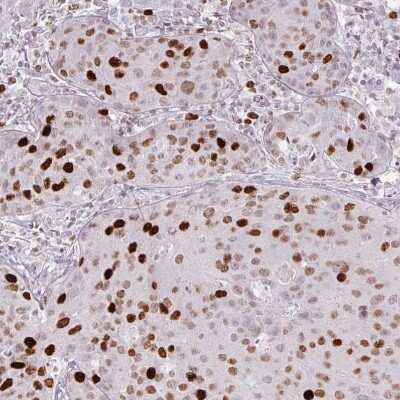 Immunohistochemistry-Paraffin: ATAD2 Antibody (CL0182) [NBP2-14786]