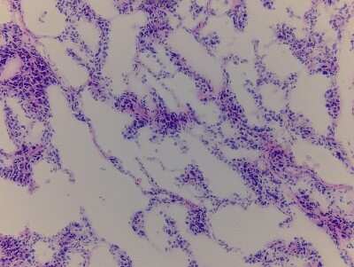 Hematoxylin & Eosin Stain: Adrenal Tissue Slides (Tumor)- Frozen [NBP2-77630]