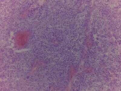 Hematoxylin & Eosin Stain: Bladder Tissue Slides (Tumor)- Frozen [NBP2-77631]