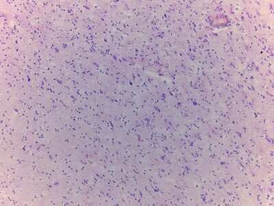 Hematoxylin & Eosin Stain: Brain Tissue Slides (Tumor)- Frozen [NBP2-77633]