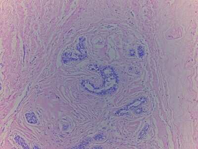 Hematoxylin & Eosin Stain: Breast Matched Tumor and Normal Tissue Slides (Tumor)- Paraffin [NBP2-77977]