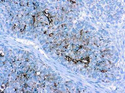 Immunohistochemistry-Paraffin: CA125/MUC16 Antibody (OV185-1) [NBP1-22564]