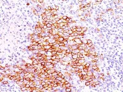 Immunohistochemistry-Paraffin: CD30/TNFRSF8 Antibody (CD30/412) - Azide and BSA Free [NBP2-33196]