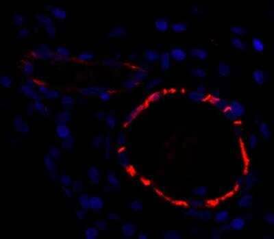 Immunohistological Staining of CD31/PECAM-1 in Paraffin Embedded Human Breast Carcinoma