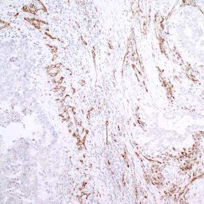 Staining of CD31/PECAM-1 in Paraffin Embedded Human Lung Adenocarcinoma