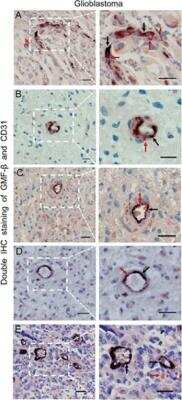 Immunohistological Staining of CD31/PECAM-1 in Multiple Human Glioblastoma Sections