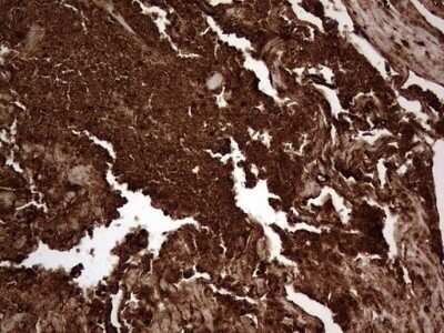 Immunohistochemistry: CEACAM5/CD66e Antibody (OTI3D8) - Azide and BSA Free [NBP2-70407]