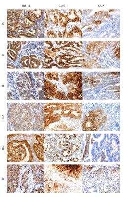 Immunohistological Staining of Carbonic Anhydrase IX/CA9 in Endometrial Cancer