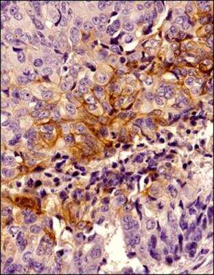 Immunohistochemical Staining of Carbonic Anhydrase IX/CA9 in Paraffin Embedded Human Breast Cancer
