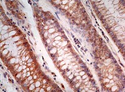 Immunohistological Staining of Caspase-1 in Paraffin Embedded Adenocarcinoma of the Rectum