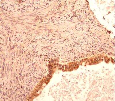 Immunohistological Staining of Caspase-1 in Paraffin Embedded Human Ovarian Cancer