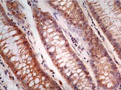 Immunohistological Staining of Caspase-1 in Paraffin Embedded Adenocarcinoma of the Rectum