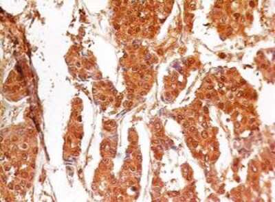 Immunohistochemical Analysis of Caspase-3 in Paraffin Embedded Human Breast Cancer