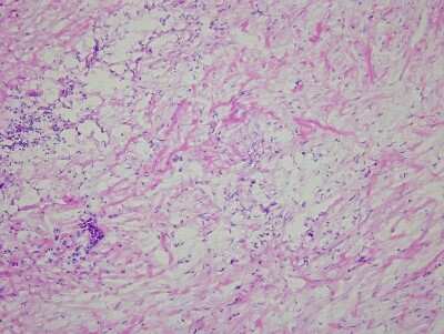 Hematoxylin & Eosin Stain: Colon Matched Primary Tumor and Metastatic Tumor Slides - Frozen [NBP2-77663]