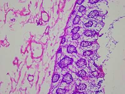 Hematoxylin & Eosin Stain: Colon Matched Tumor and Normal Tissue Slides (Tumor)- Frozen [NBP2-77670]
