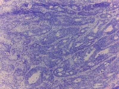 Hematoxylin & Eosin Stain: Colon Tissue Slides (Tumor)- Frozen [NBP2-77635]