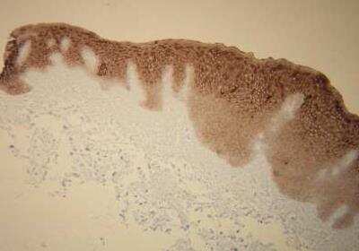 Immunohistochemistry-Paraffin: Cytokeratin 5/6 Antibody (T16-K) [NBP2-36738]