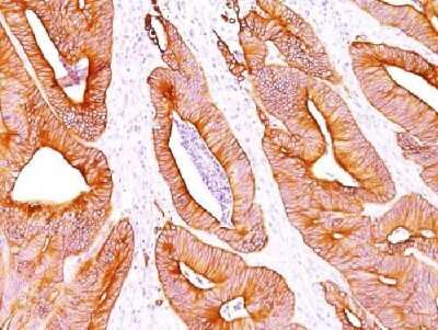 Immunohistochemical Staining of Cytokeratin, pan in Paraffin Embedded Human Colon Carcinoma