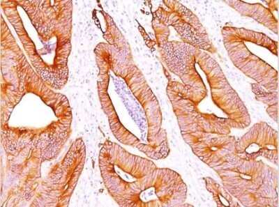 Immunohistochemical Staining of Cytokeratin, pan in Paraffin Embedded Human Colon Carcinoma