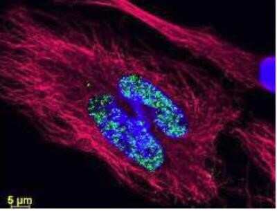 Immunofluorescent Staining of Human Breast Carcinoma Tissue Using DyLight 488 Conjugated GFP Antibody