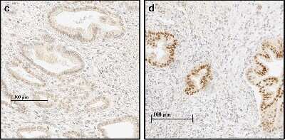 Immunohistological Detection of HIF-1 alpha in PDAC and Adjacent Normal Pancreatic Tissue